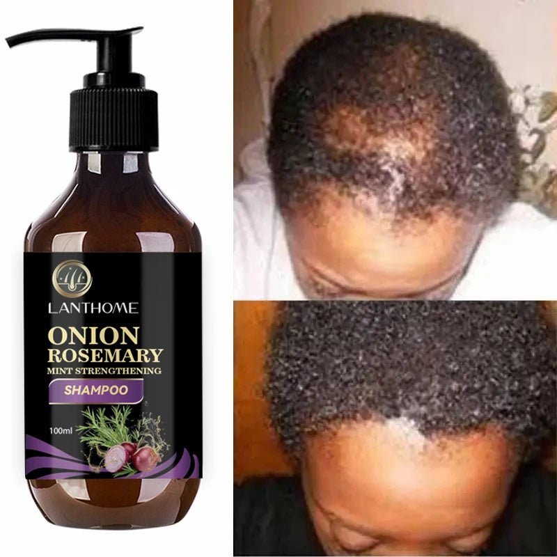 Hair Shampoo For Fast Hair Growth Rosemary Onion Shampoo 30ML Spray Anti Hair Loss Effective Within 7 Day Hair Growth - Japan 4 All